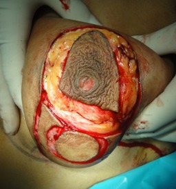 18-anhos-de-oncoplastia