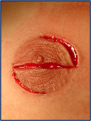 ginecomastia-incision-Z